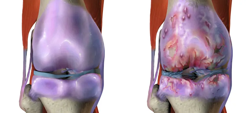 Ilustrasi osteoartritis lutut