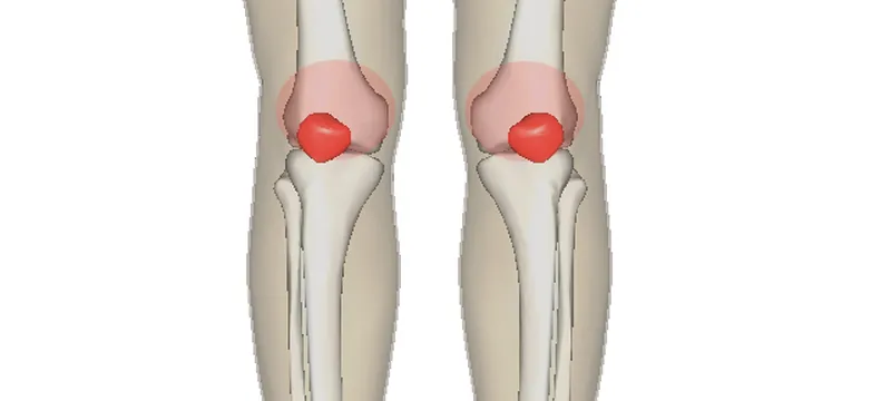 Ilustrasi kondisi patellofemoral